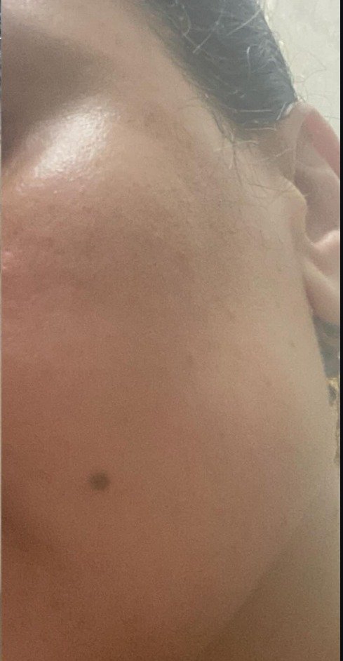 After Dermapen and Brightening Treatment