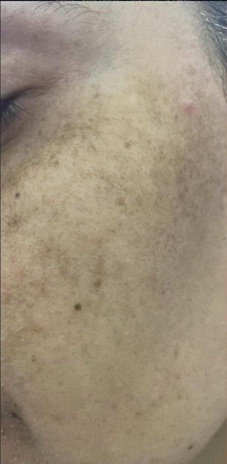 Before Dermapen and Brightening Treatment